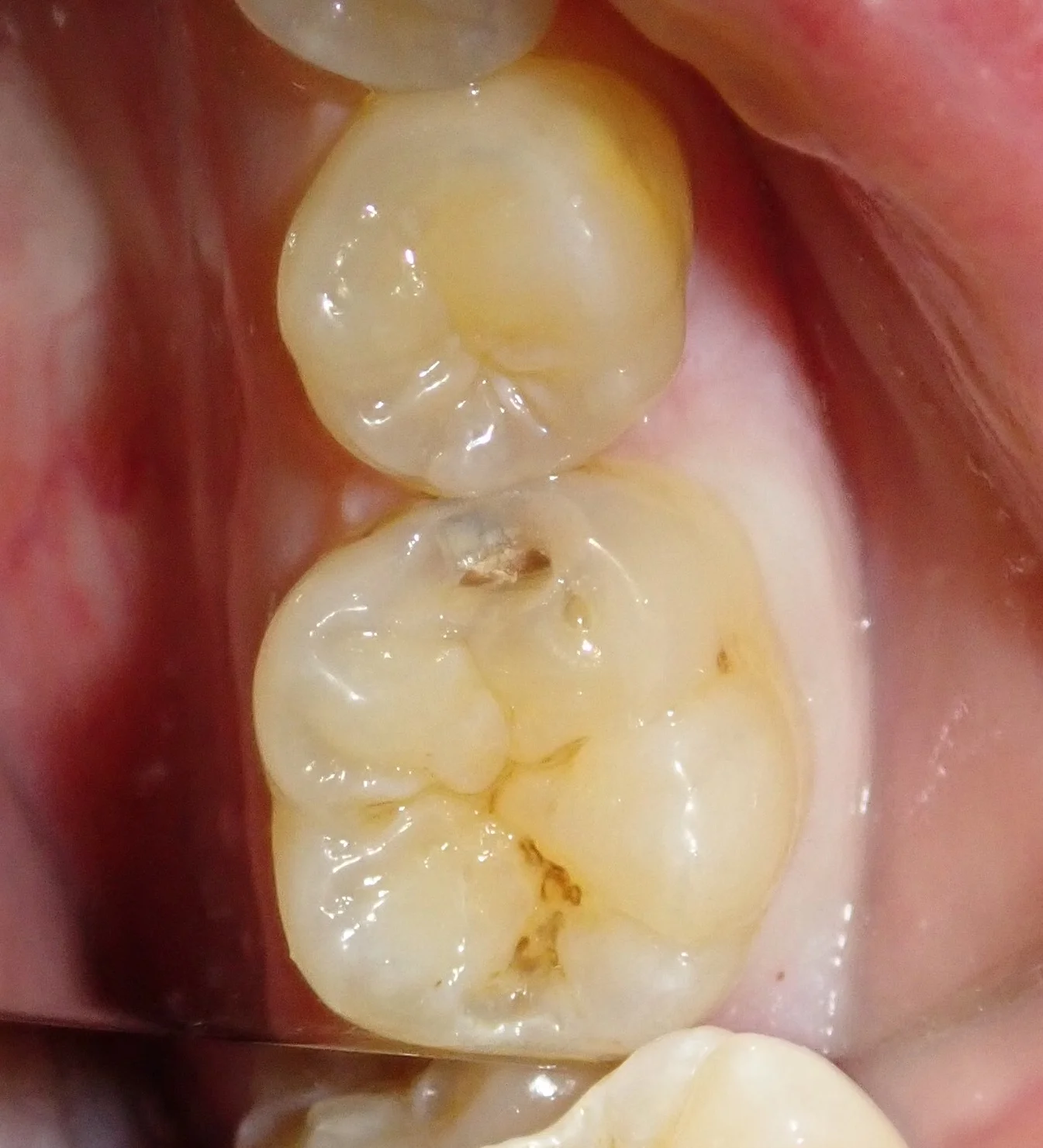 虫歯はない・・・?本当に・・・?|坂寄歯科医院(取手市藤代) - 画像2