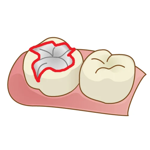 歯を可及的に温存したブリッジ｜坂寄歯科医院（取手市藤代） - 画像4