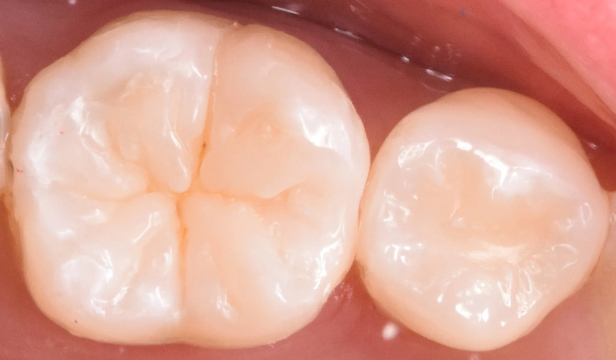 奥歯を白い詰め物で治療。｜坂寄歯科医院（取手市藤代） - 画像3