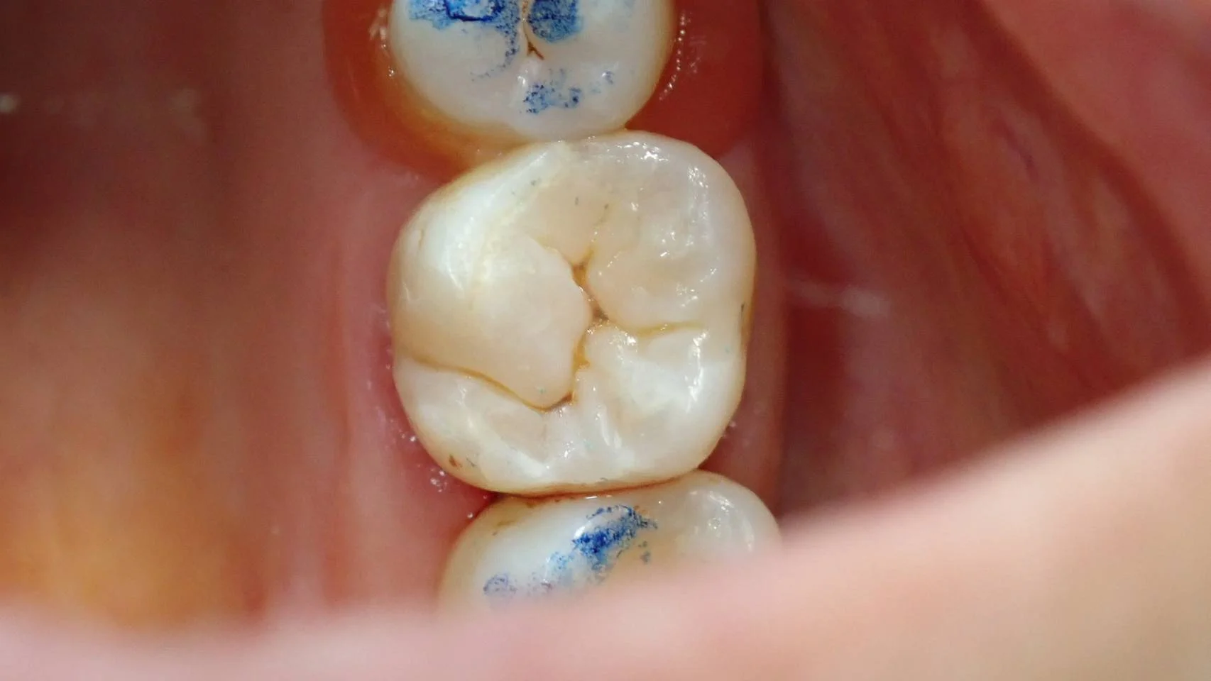 ダイレクトボンディング⑤|坂寄歯科医院(取手市藤代) - 画像2