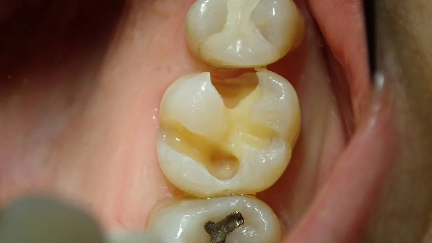 ブログ・お役立ち情報｜坂寄歯科医院（取手市藤代）