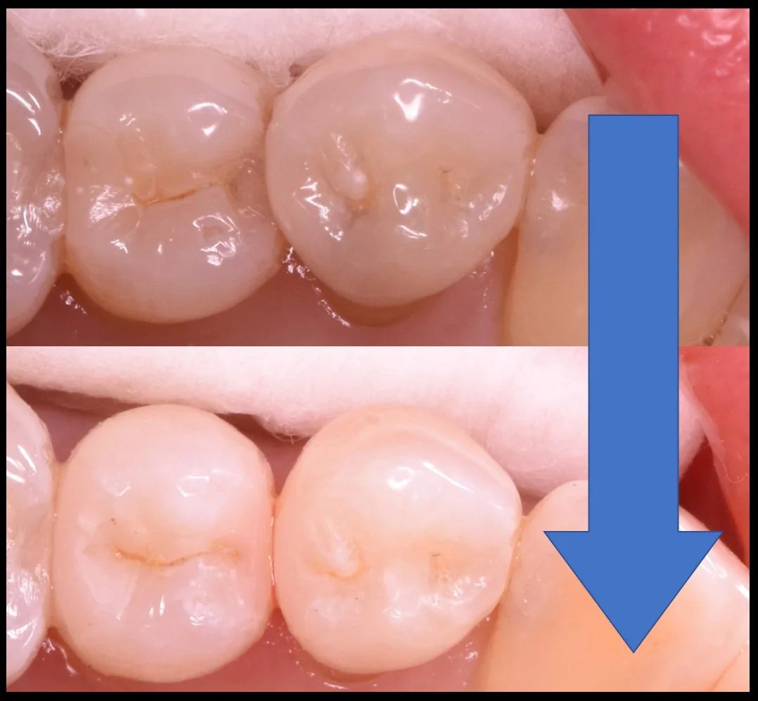 奥歯の歯並びが悪くなってしまっている所の治療|坂寄歯科医院(取手市藤代) - 画像7