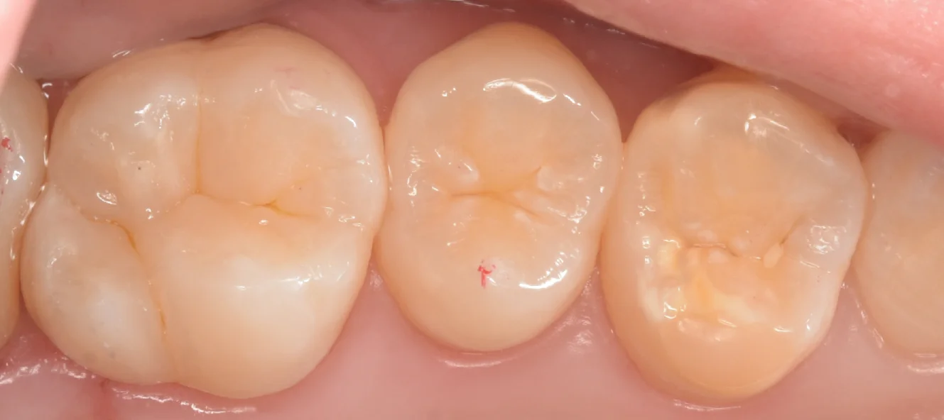 自費の白い詰め物。|坂寄歯科医院(取手市藤代) - 画像4