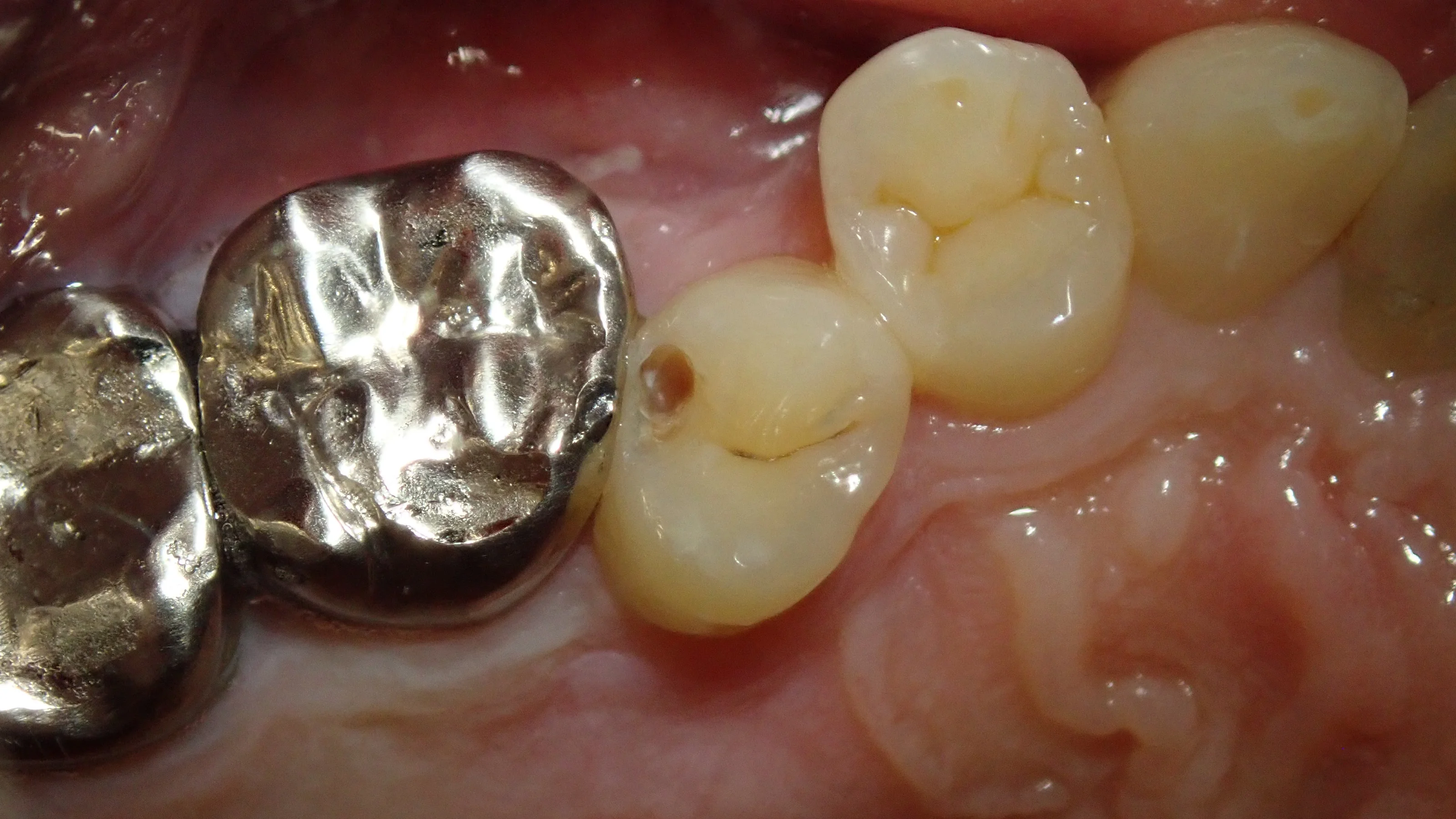 左上3本まとめてダイレクトボンディング｜坂寄歯科医院（取手市藤代） - 画像5