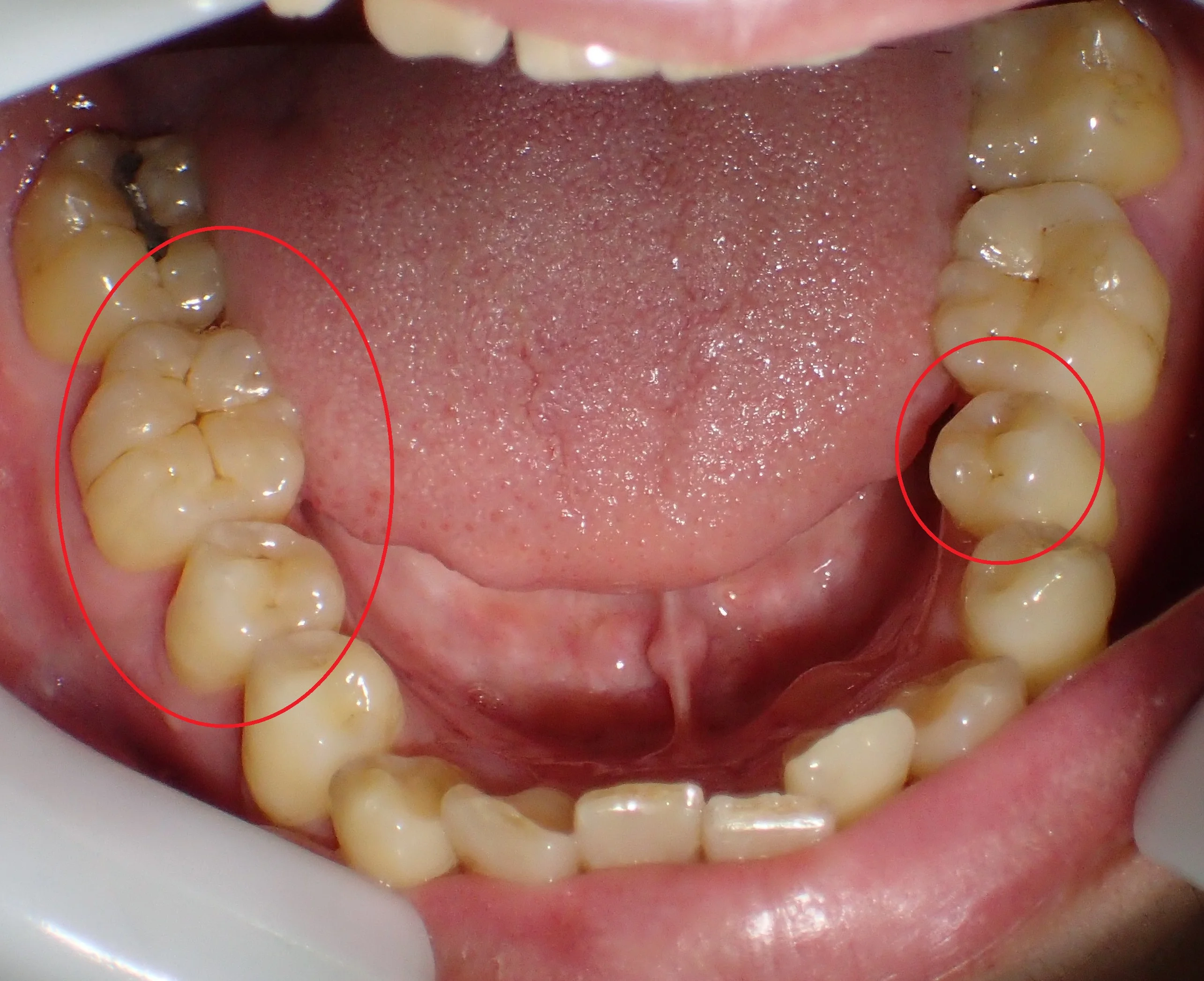 ダイレクトボンディングによる治療|坂寄歯科医院(取手市藤代) - 画像4