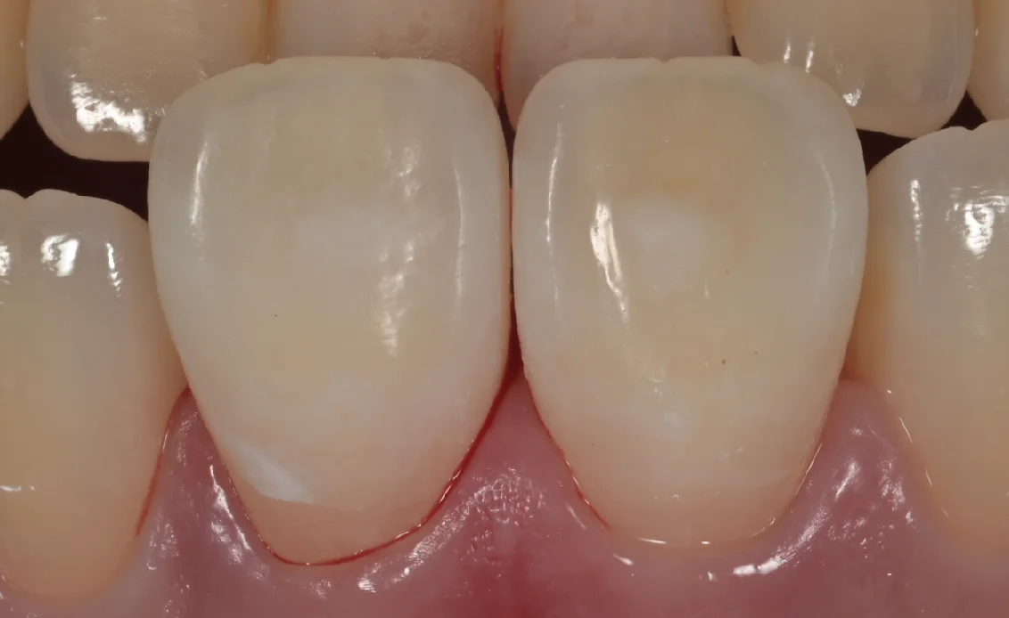 ICON治療。｜坂寄歯科医院（取手市藤代） - 画像6