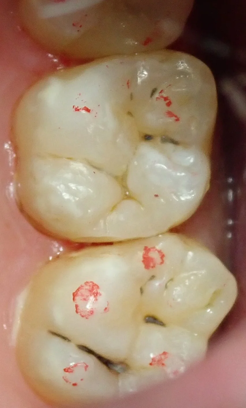 右上奥歯の治療｜坂寄歯科医院（取手市藤代） - 画像3