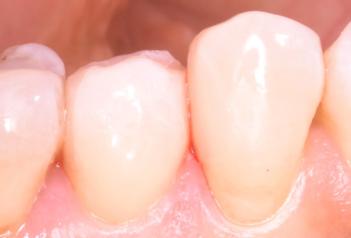 奥歯の歯並びが悪くなってしまっている所の治療|坂寄歯科医院(取手市藤代) - 画像6