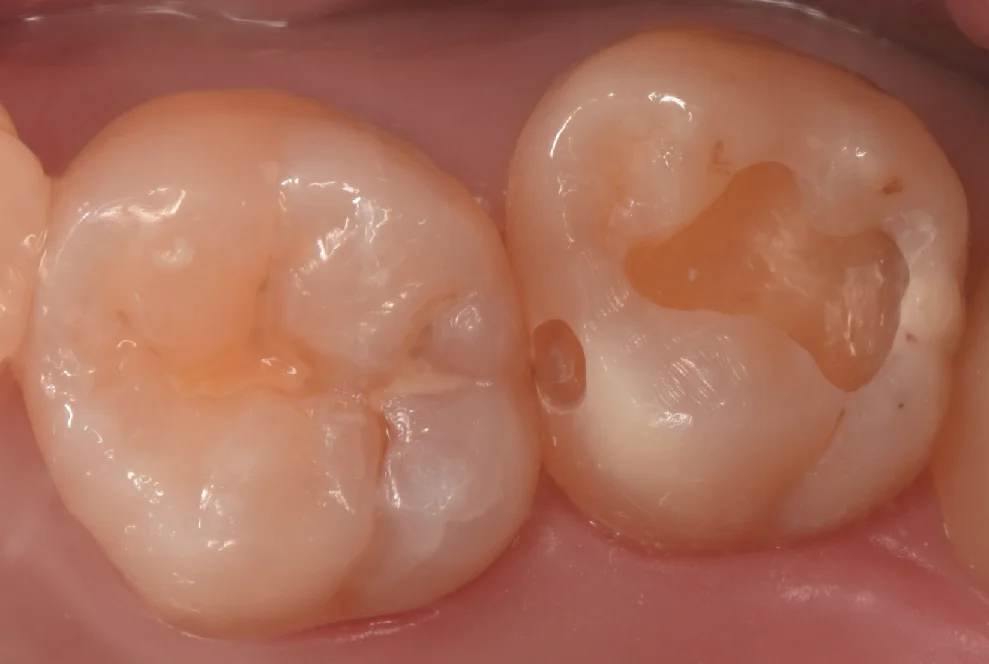 新しくできた虫歯と古い詰め物を同時に治療。|坂寄歯科医院(取手市藤代) - 画像3