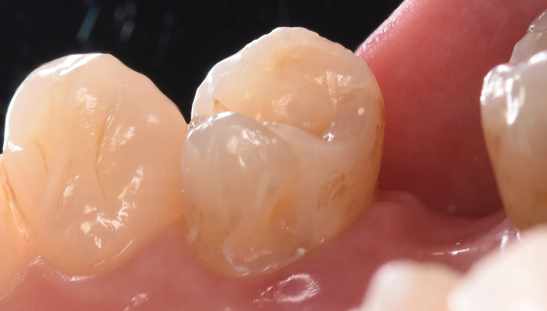 ダイレクトボンディング術後4年での補修修復｜坂寄歯科医院（取手市藤代） - 画像4