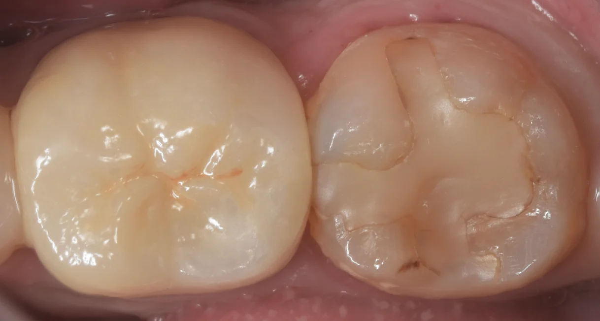 古い白い詰め物を詰め直し｜坂寄歯科医院（取手市藤代） - 画像2