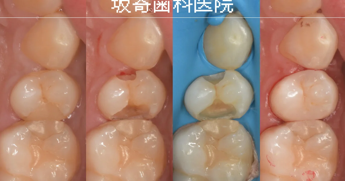 ブログ・お役立ち情報｜坂寄歯科医院（取手市藤代）