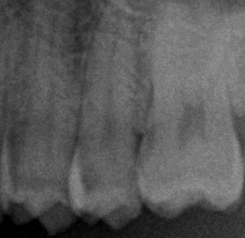 遠方から白い詰め物での治療を求めて・・・|坂寄歯科医院(取手市藤代) - 画像2