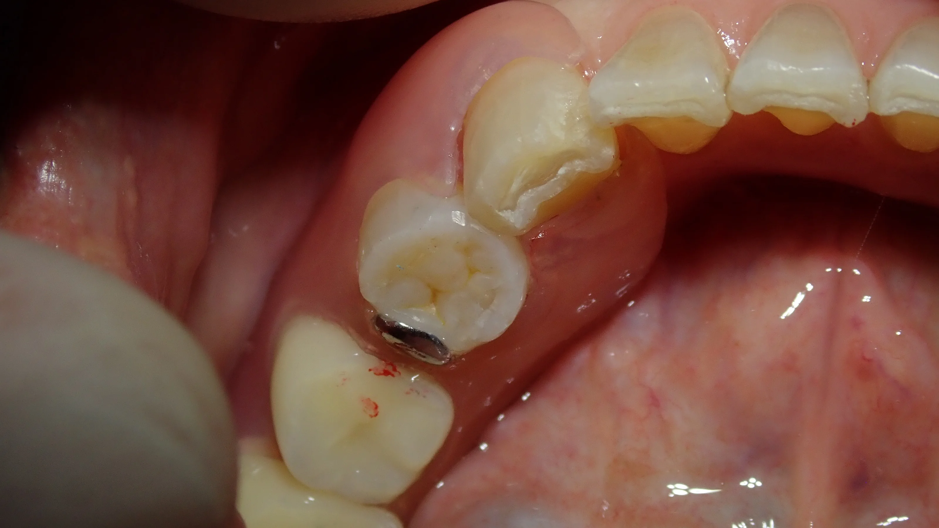 左下奥歯白い詰め物|坂寄歯科医院(取手市藤代) - 画像3