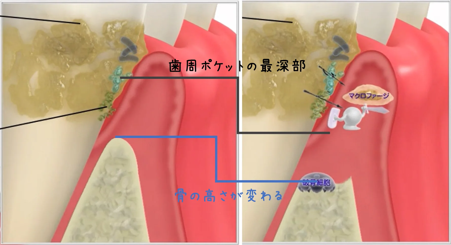 Q&A～歯周病ってなに？②～｜坂寄歯科医院（取手市藤代） - 画像4