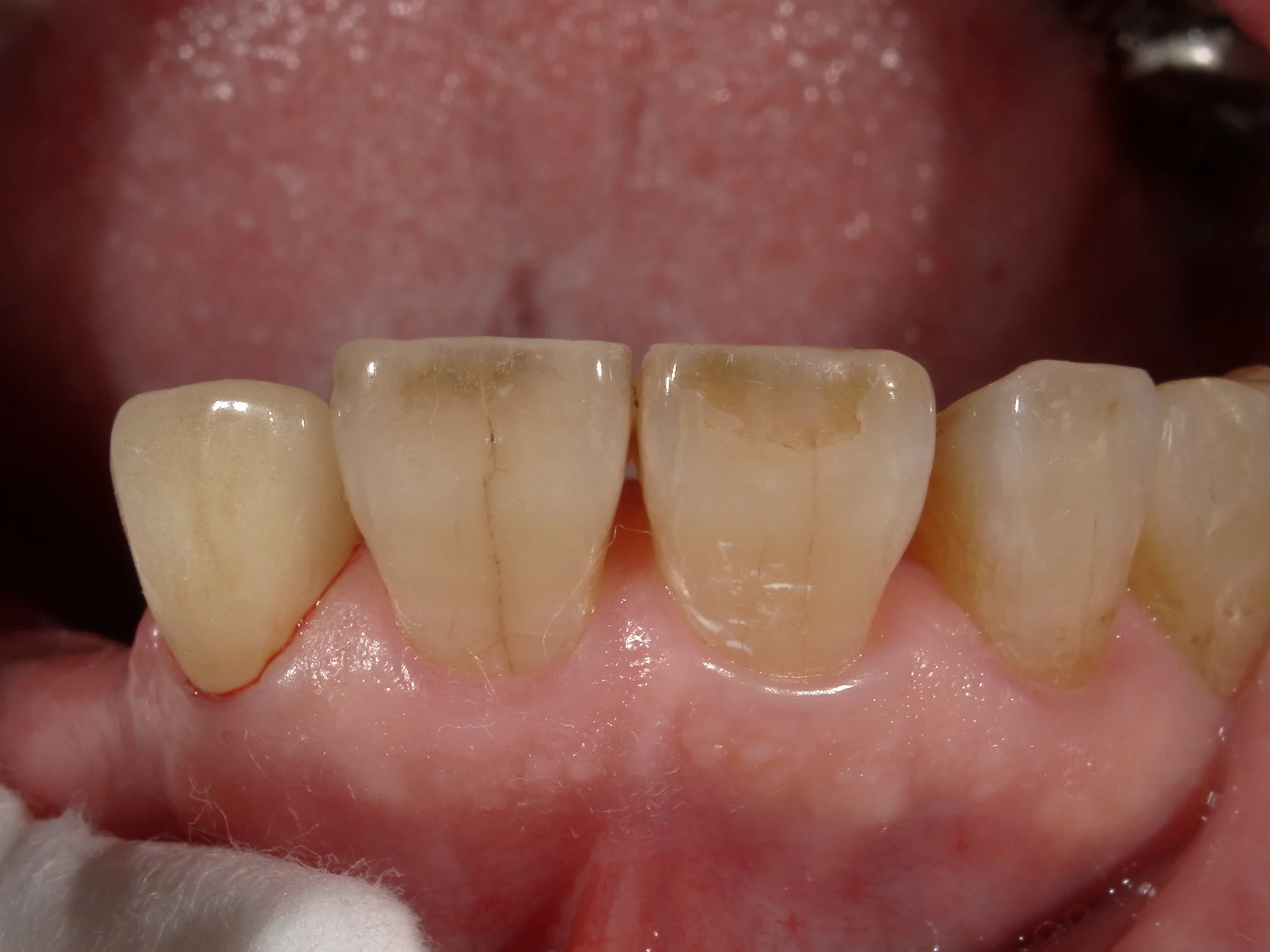 セラミックでの色の再現度を上げるために・・・|坂寄歯科医院(取手市藤代) - 画像3