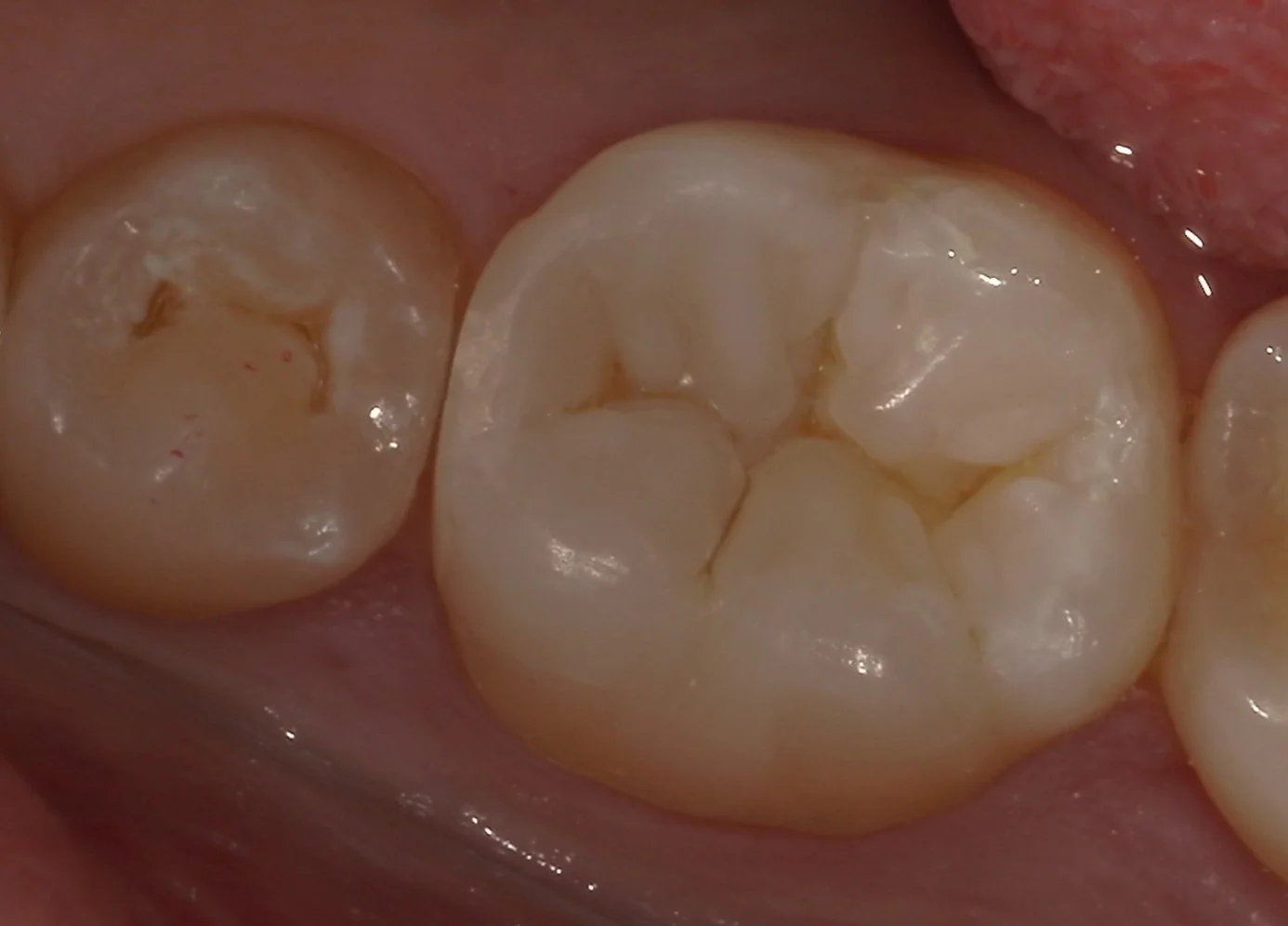 難易度の高い白い詰め物。｜坂寄歯科医院（取手市藤代） - 画像5