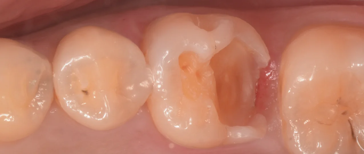 歯科医師の方のCAD/CAMインレーを治療。|坂寄歯科医院(取手市藤代) - 画像3