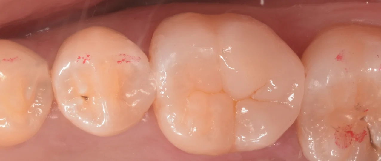 歯科医師の方のCAD/CAMインレーを治療。|坂寄歯科医院(取手市藤代) - 画像4