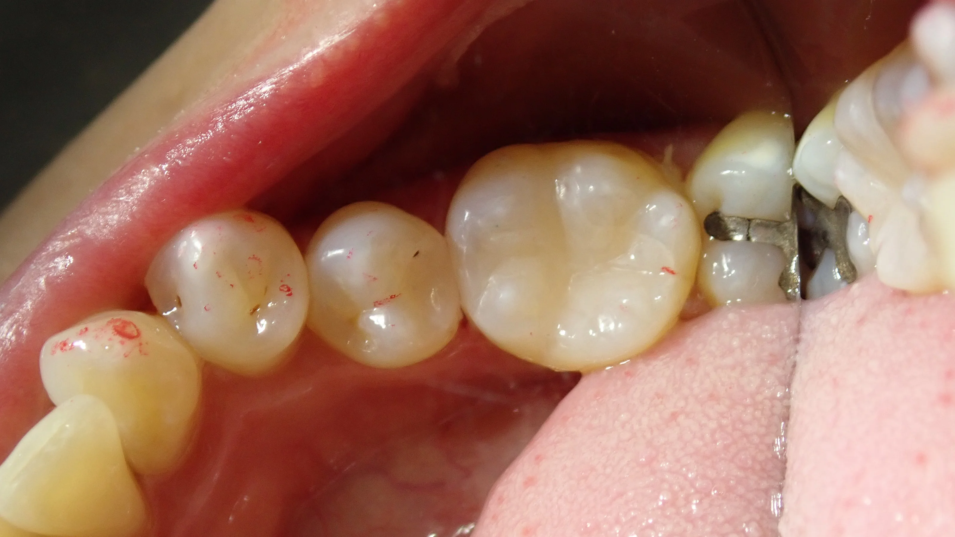 下の奥歯2本の詰め物｜坂寄歯科医院（取手市藤代） - 画像4