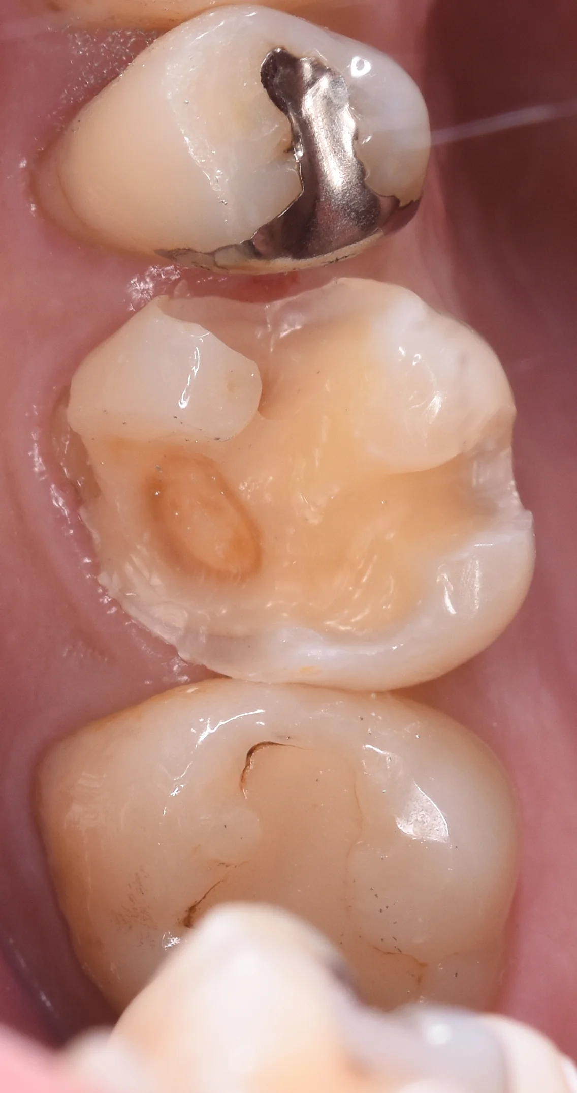 金属を白い詰め物に。|坂寄歯科医院(取手市藤代) - 画像2