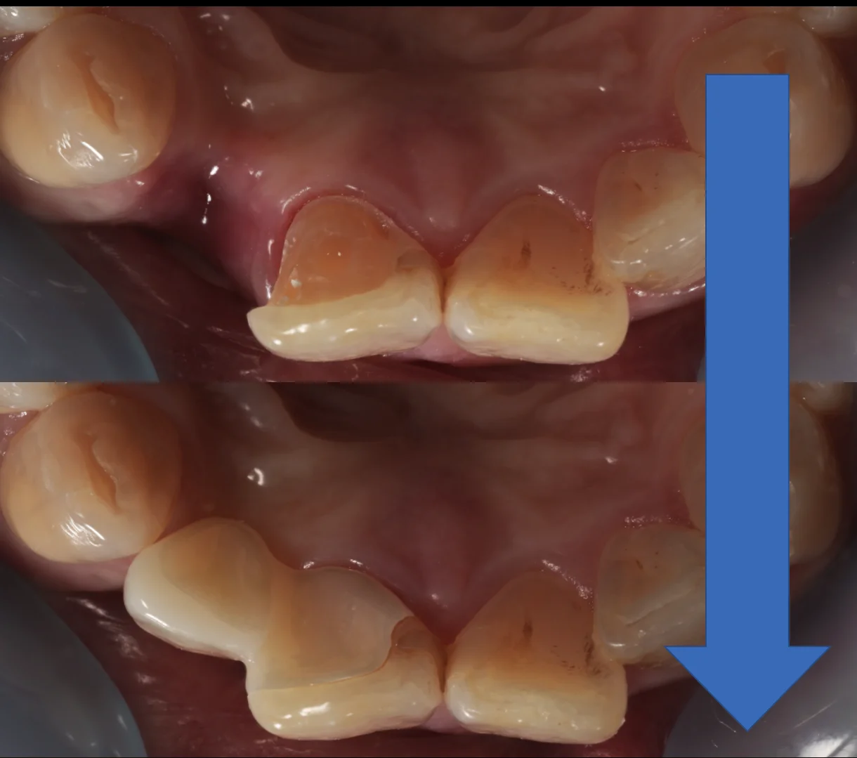 審美治療+歯質保存:延長セラミックブリッジ|坂寄歯科医院(取手市藤代) - 画像7