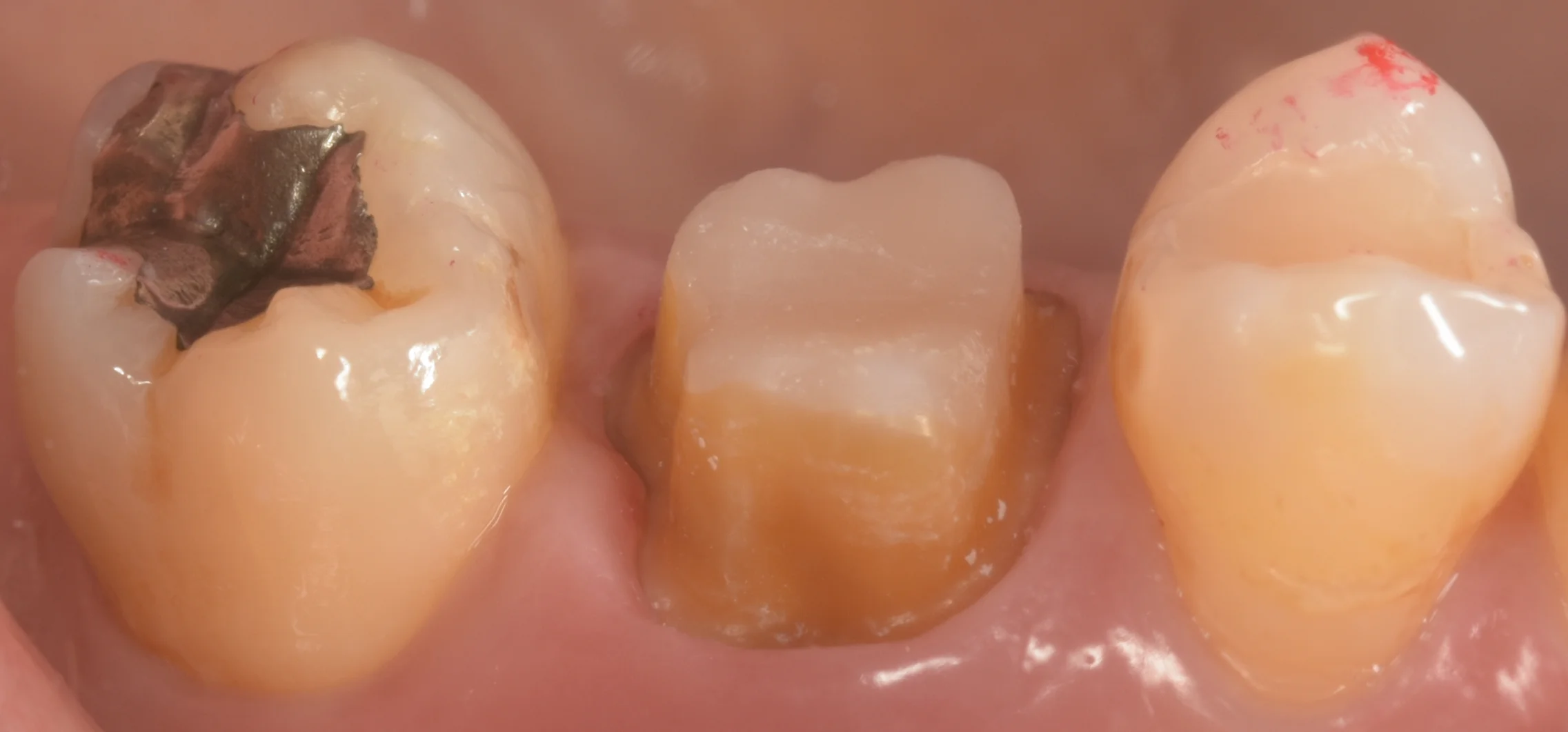 セラミックの被せ物｜坂寄歯科医院（取手市藤代） - 画像2