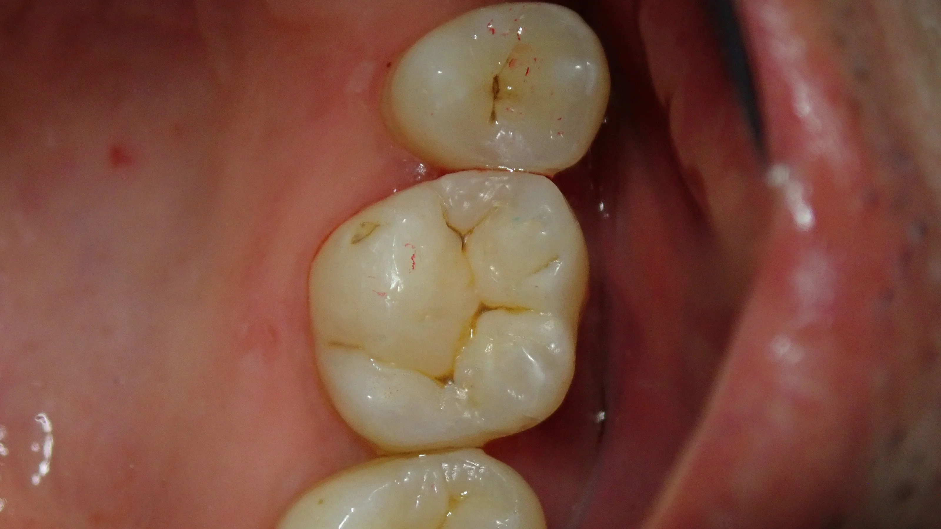 ダイレクトボンディング⑨｜坂寄歯科医院（取手市藤代） - 画像4