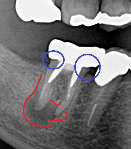 パーフォレーションリペア|坂寄歯科医院(取手市藤代) - 画像2