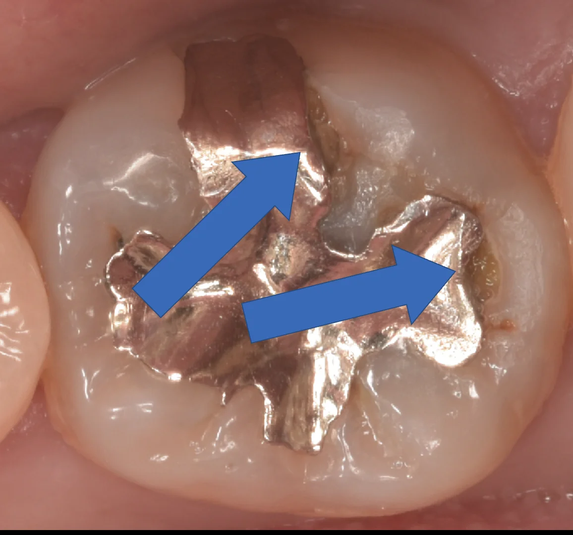 印西からお越しの方｜坂寄歯科医院（取手市藤代） - 画像2