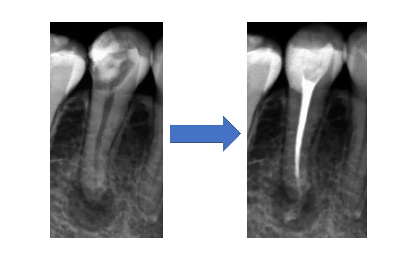 神経の治療③|坂寄歯科医院(取手市藤代) - 画像3