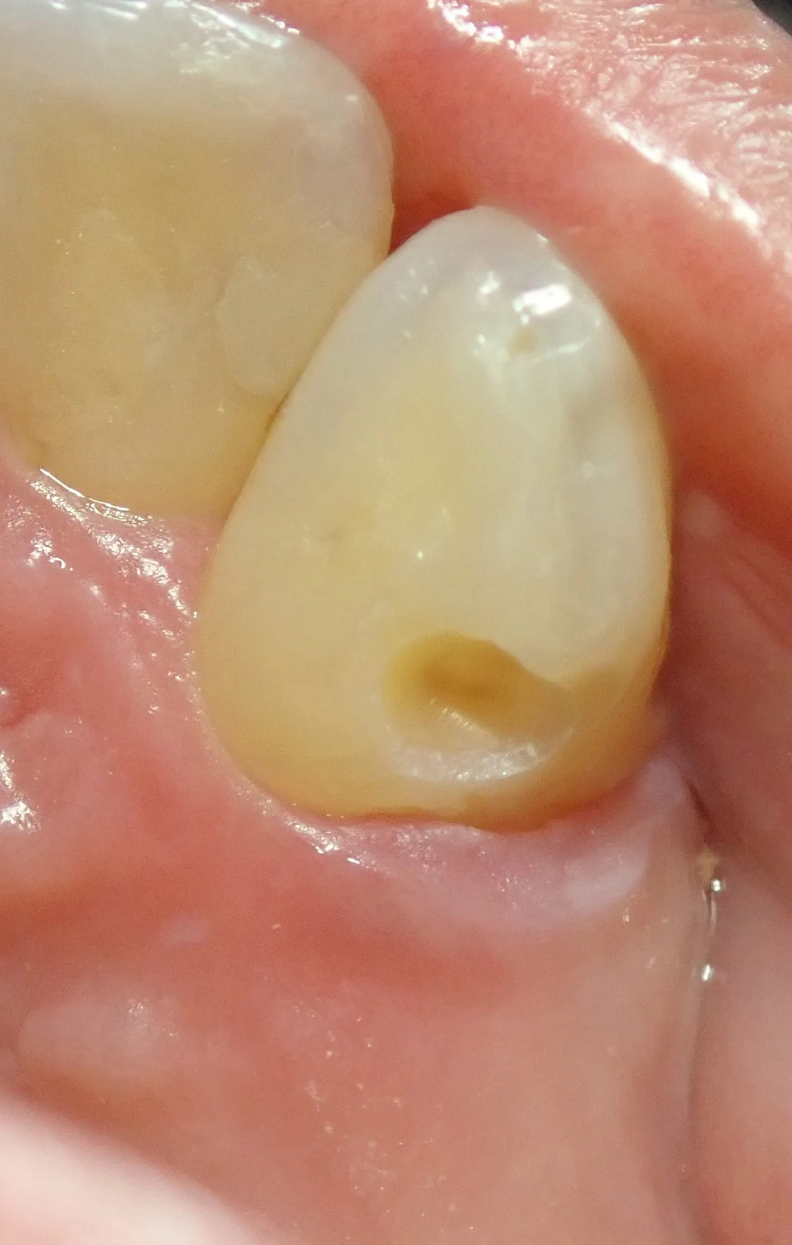 右上犬歯の白い詰め物|坂寄歯科医院(取手市藤代) - 画像5