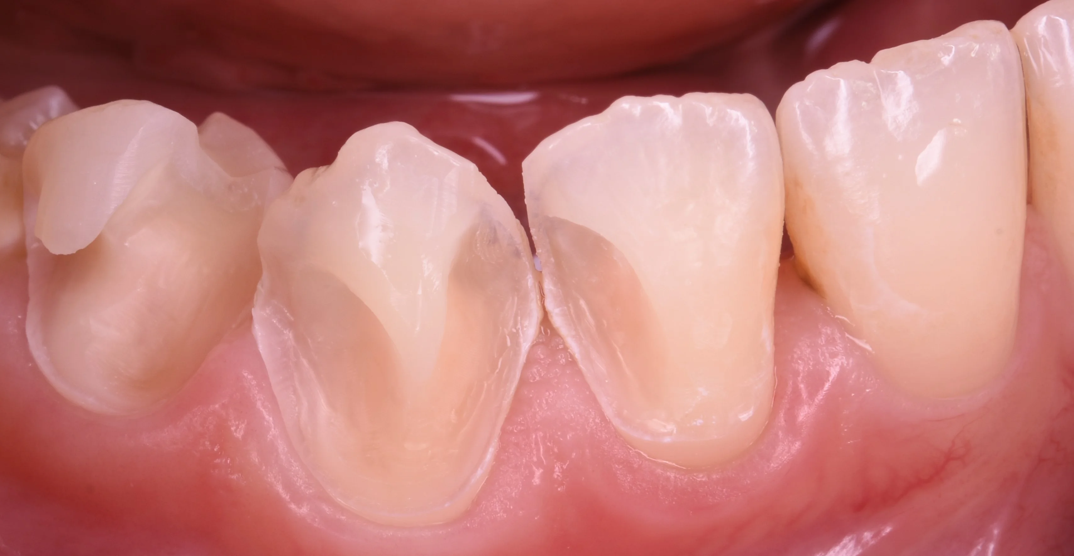 前歯を纏めて白く。|坂寄歯科医院(取手市藤代) - 画像2