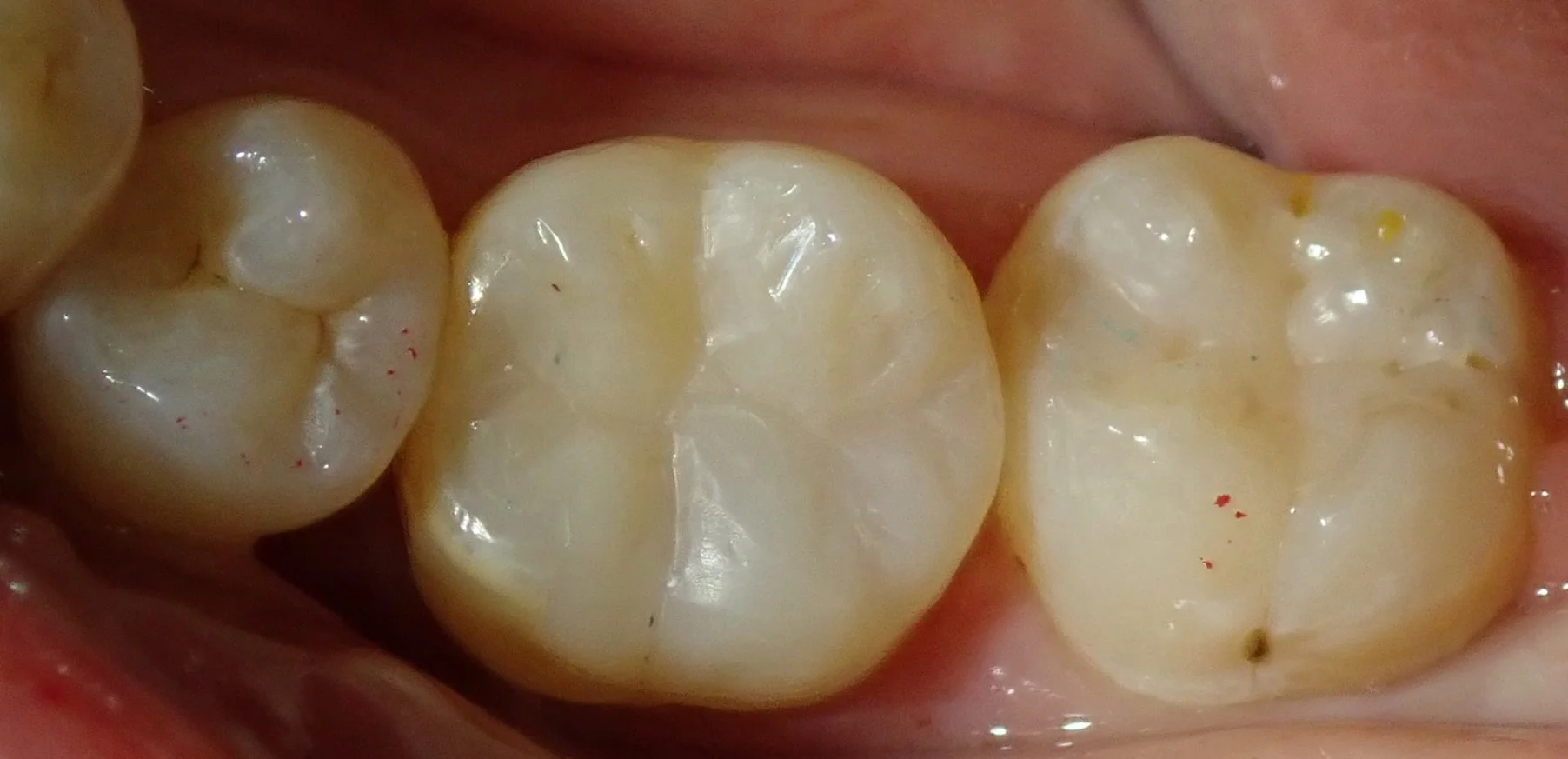 奥歯の白い詰め物|坂寄歯科医院(取手市藤代) - 画像4