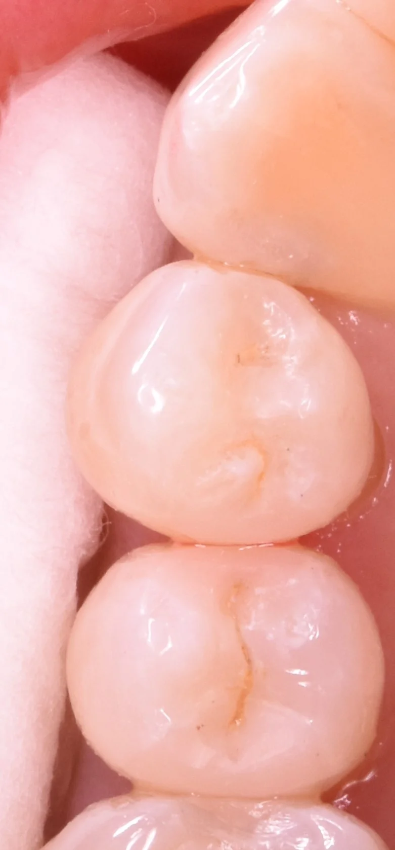 奥歯の歯並びが悪くなってしまっている所の治療|坂寄歯科医院(取手市藤代) - 画像5