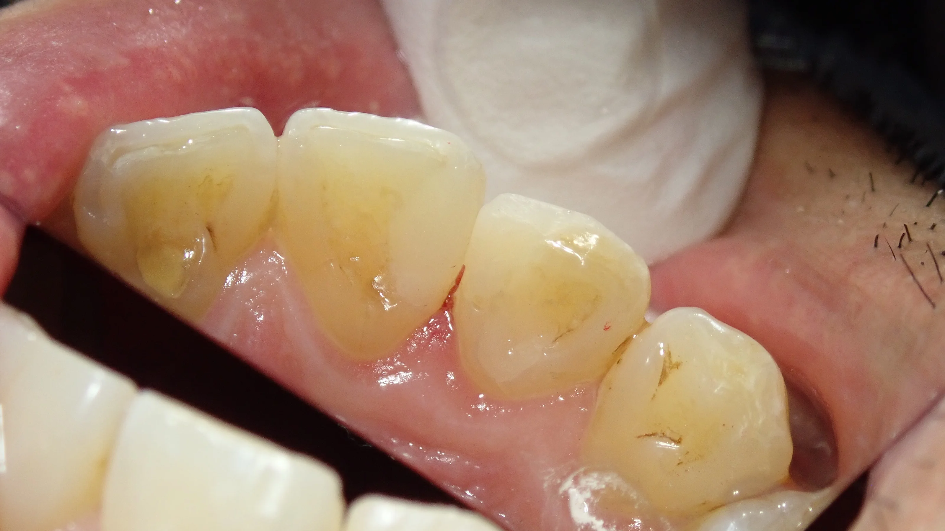 前歯の白い詰め物｜坂寄歯科医院（取手市藤代） - 画像8