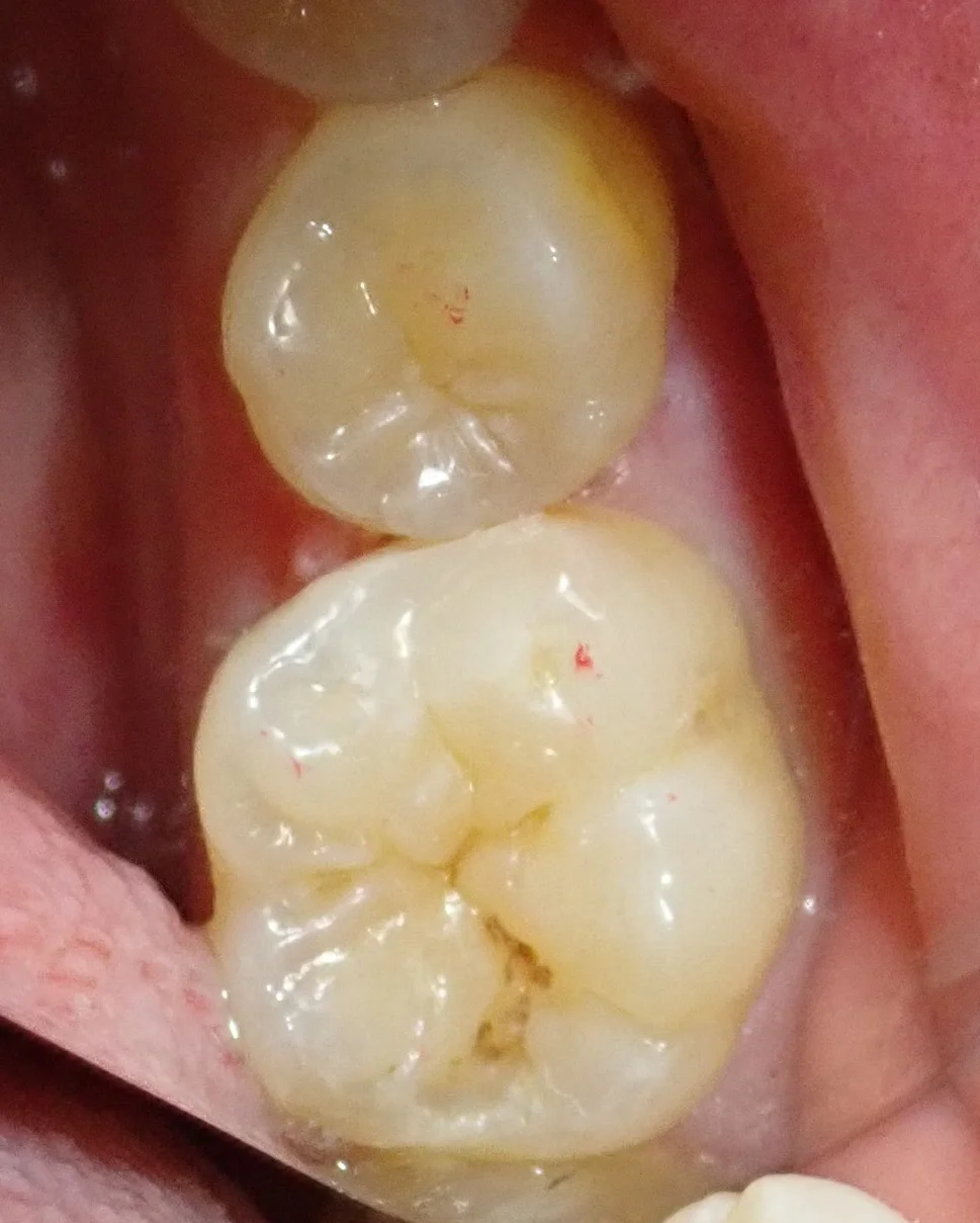 虫歯はない・・・?本当に・・・?|坂寄歯科医院(取手市藤代) - 画像4