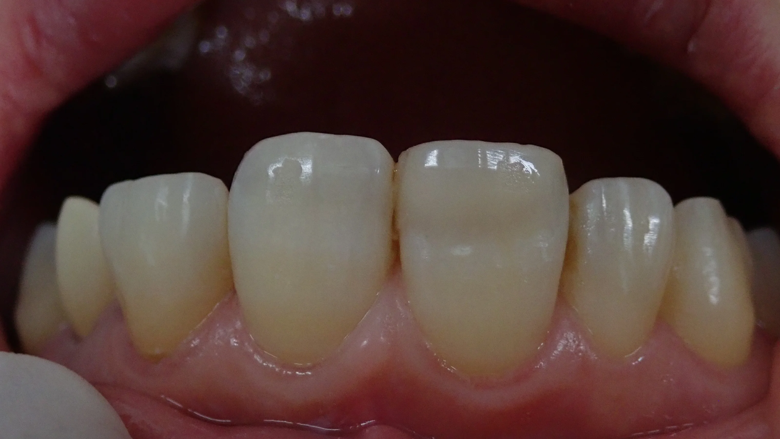 前歯ダイレクトボンディング②｜坂寄歯科医院（取手市藤代） - 画像4