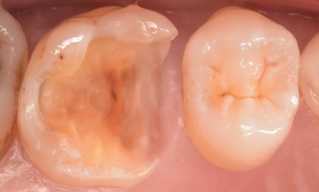 歯科医師の方を治療。｜坂寄歯科医院（取手市藤代） - 画像3