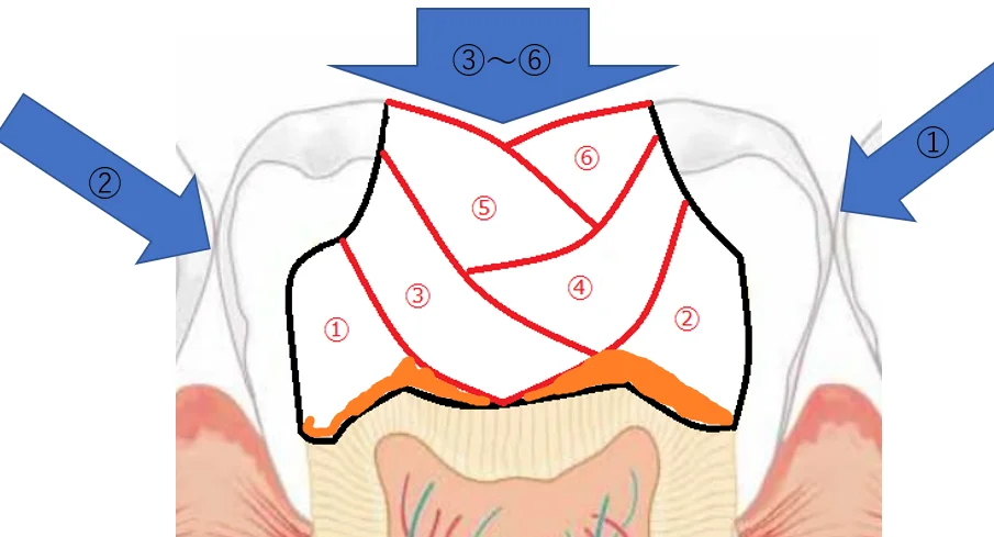 【歯科医師向け】重合収縮のコントロールについて【1級窩洞編】｜坂寄歯科医院（取手市藤代） - 画像6