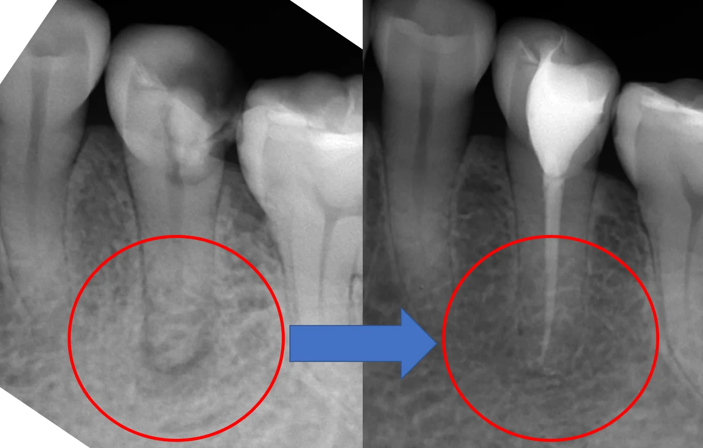 詰め物が欠けたまま放置した結果・・・|坂寄歯科医院(取手市藤代) - 画像4