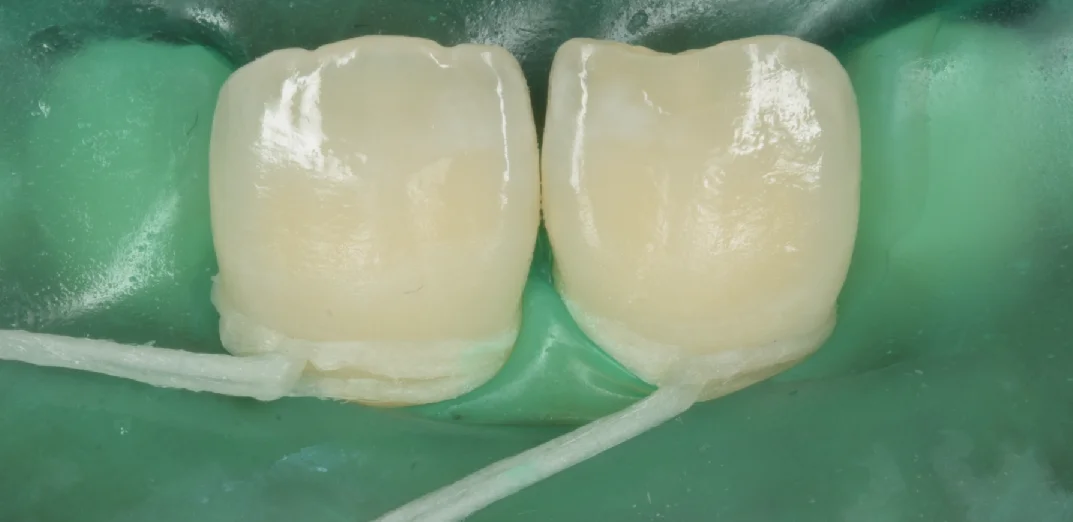 遠方よりICON治療を求めて・・・｜坂寄歯科医院（取手市藤代） - 画像3