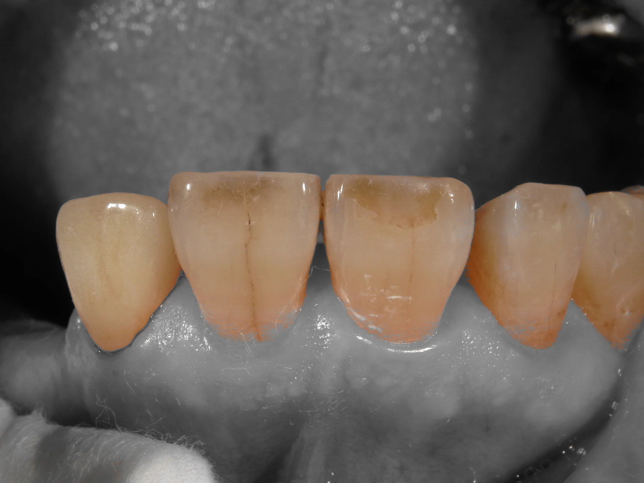 セラミックでの色の再現度を上げるために・・・|坂寄歯科医院(取手市藤代) - 画像4