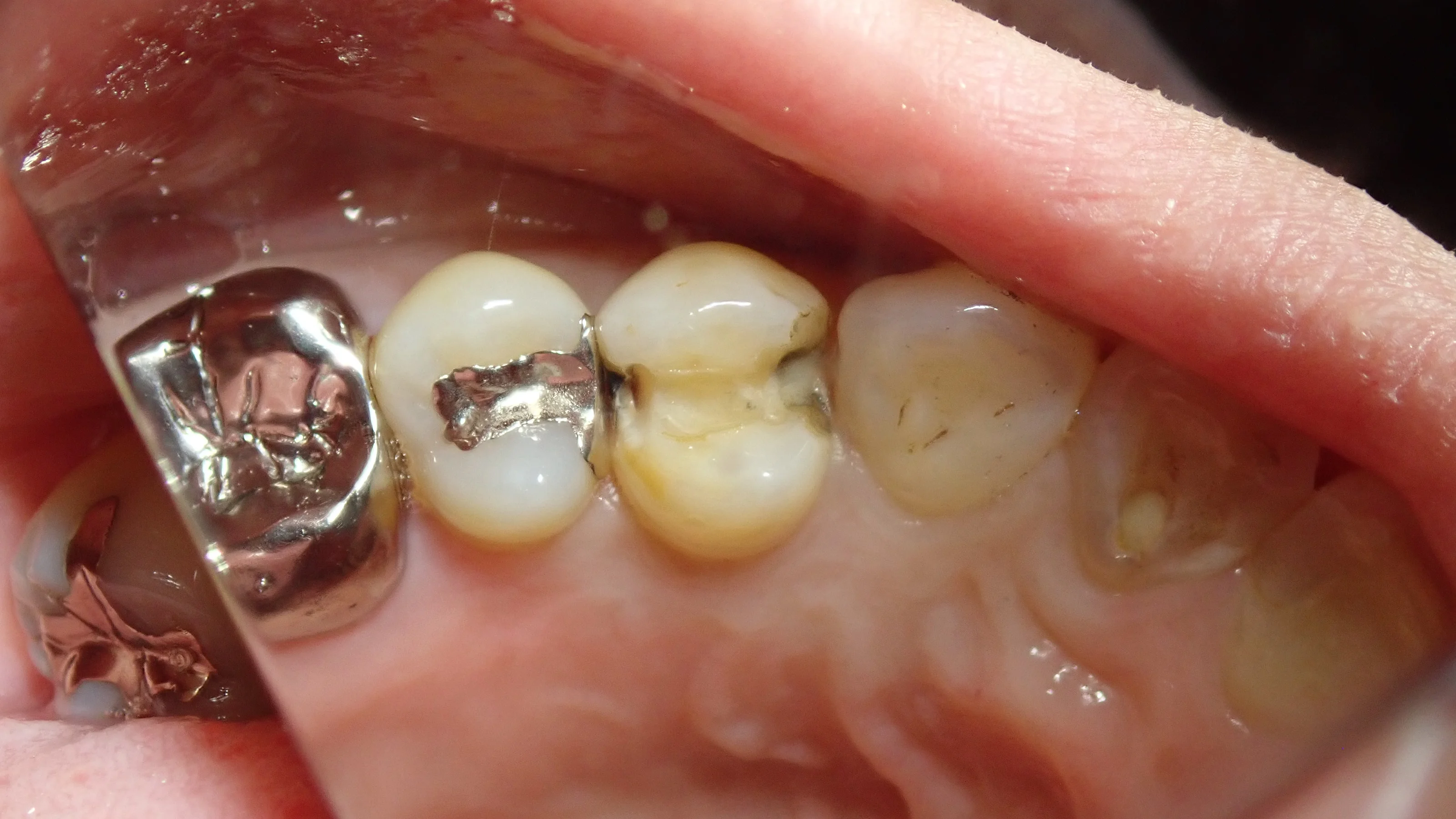 小さい奥歯(小臼歯)の白い詰め物｜坂寄歯科医院（取手市藤代） - 画像3