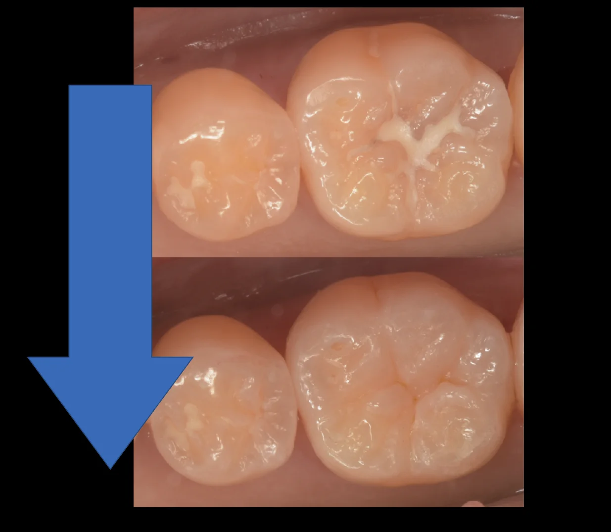 様子を見ていた所が進んだため治療介入。|坂寄歯科医院(取手市藤代) - 画像5