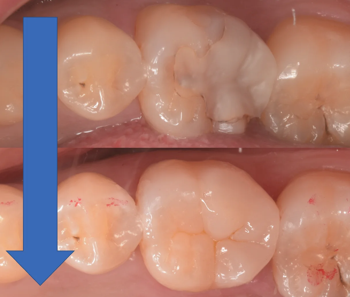 歯科医師の方のCAD/CAMインレーを治療。|坂寄歯科医院(取手市藤代) - 画像5