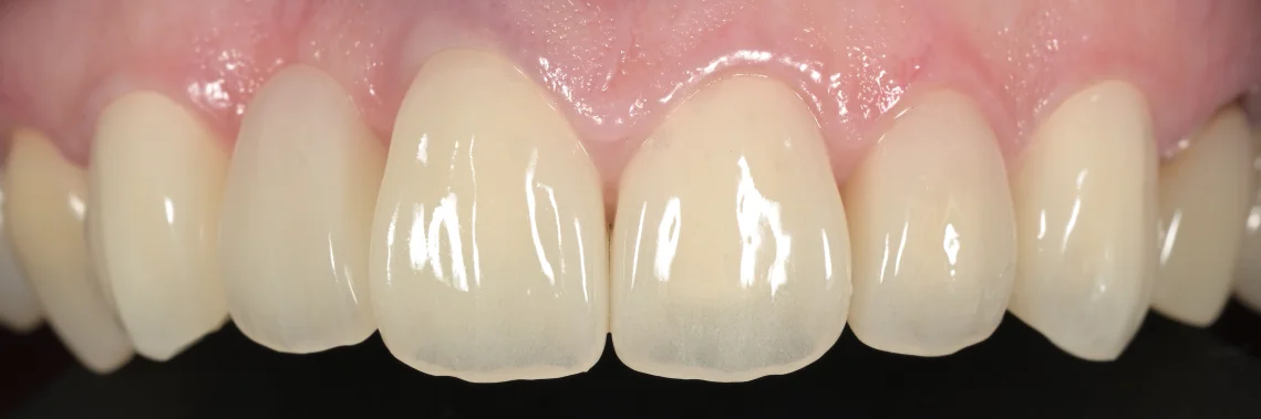 審美治療:セラミック|坂寄歯科医院(取手市藤代) - 画像2