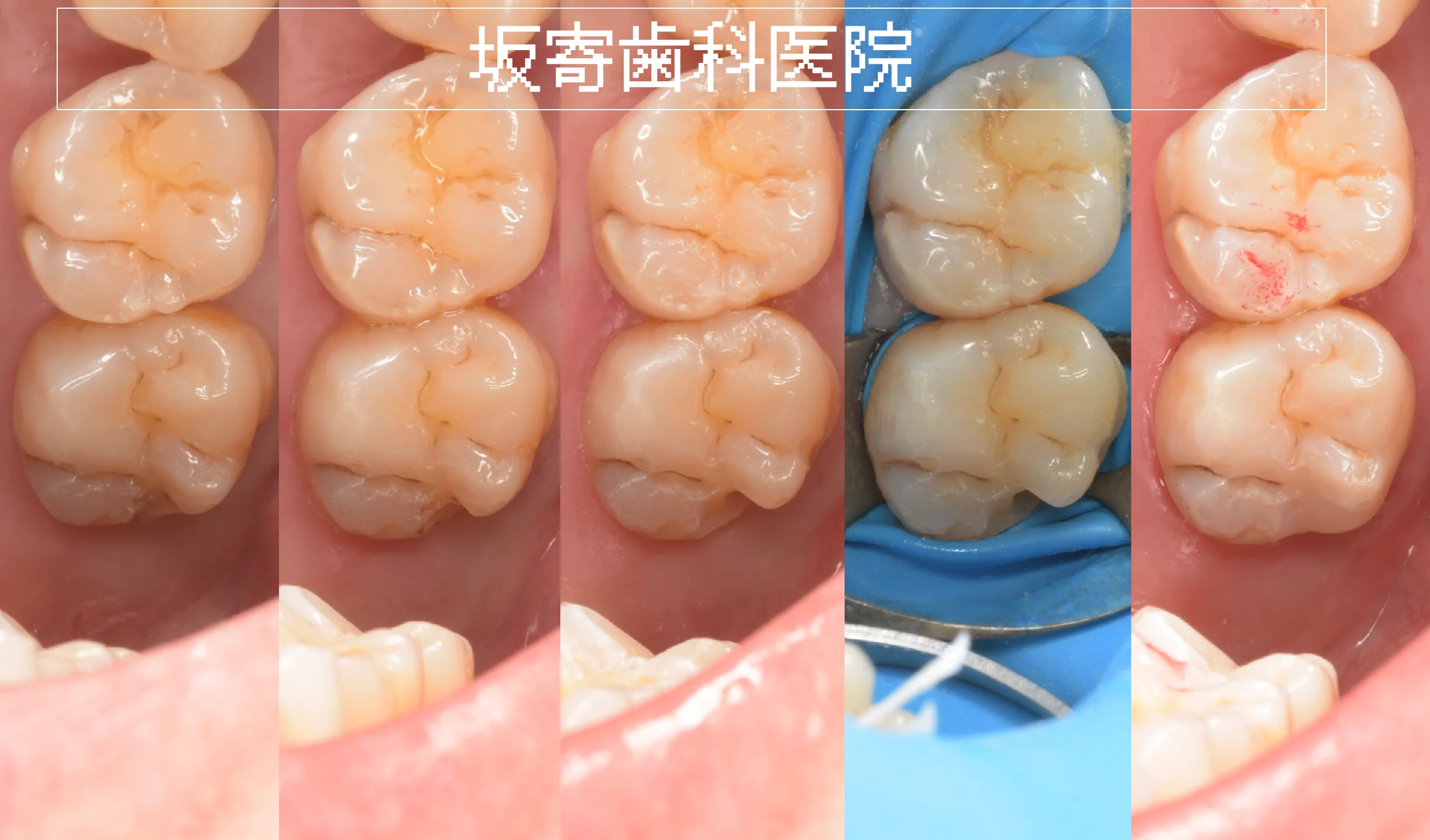 坂寄歯科医院|奥歯のダイレクトボンディング再治療の経過写真(術前/旧レジン除去/う蝕除去後/ラバーダム防湿後/研磨後)