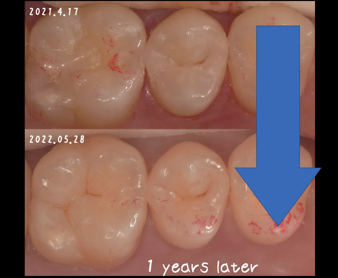 ダイレクトボンディングの長期経過｜坂寄歯科医院（取手市藤代） - 画像4