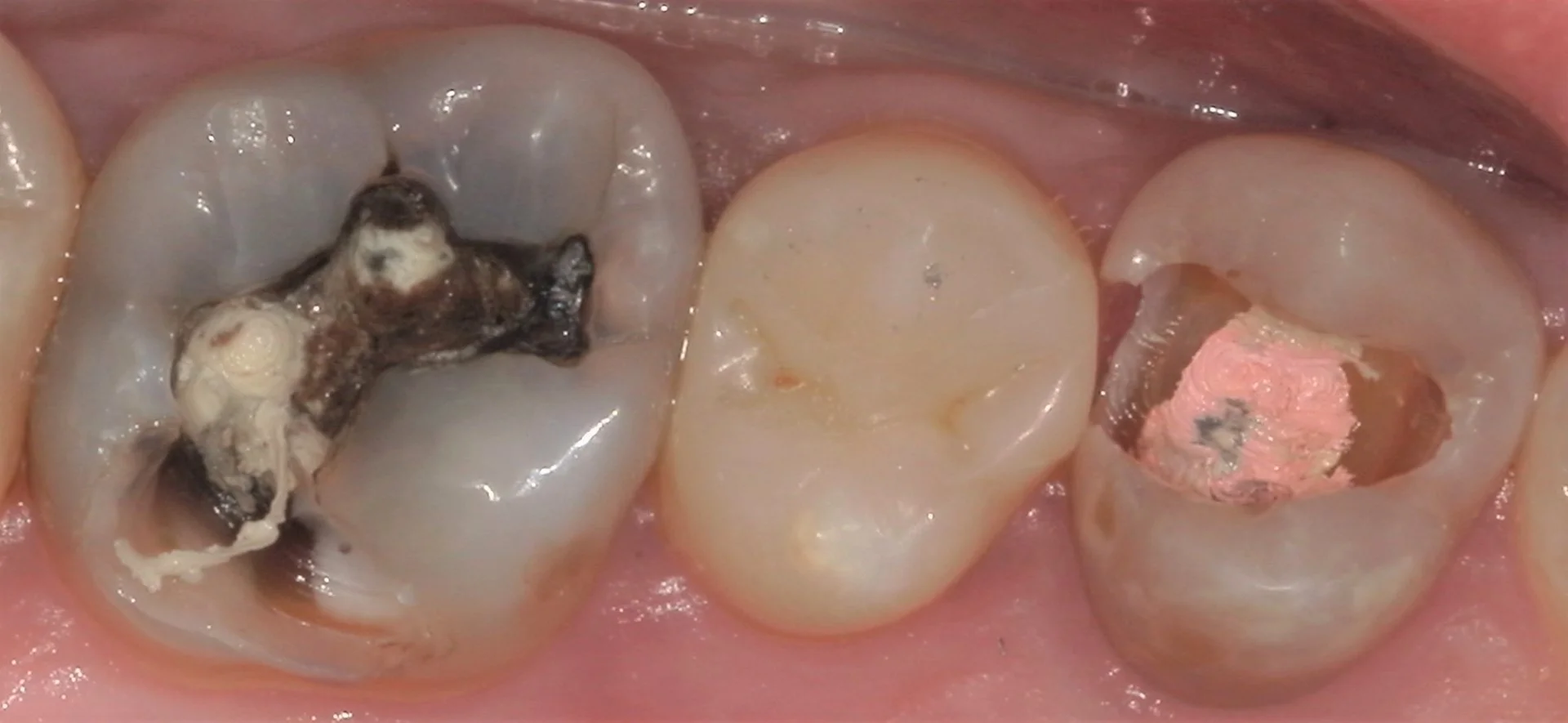 遠方から来院の方を白い詰め物にて治療。|坂寄歯科医院(取手市藤代) - 画像5